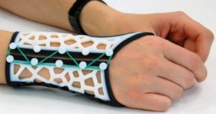 3ders.org - The software facilitates the design of 3D printing wrist splints for arthritis ...